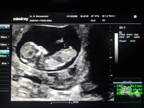 how accurate is ultrasound dating at 9 weeks